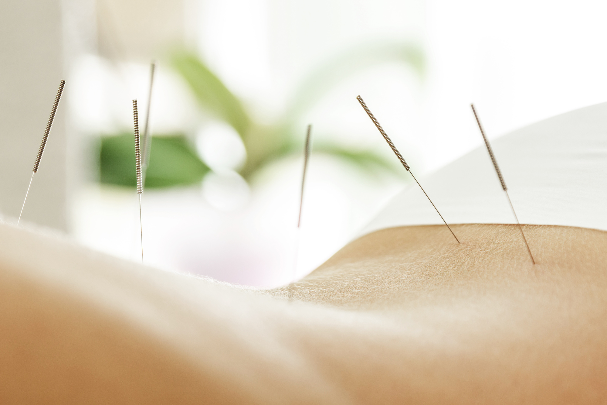 Acupuncture for Pain Management: What You Need to Know