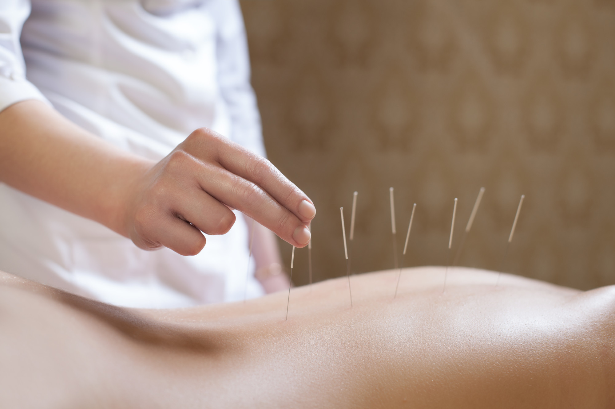 9 Impressive Health Benefits of Acupuncture